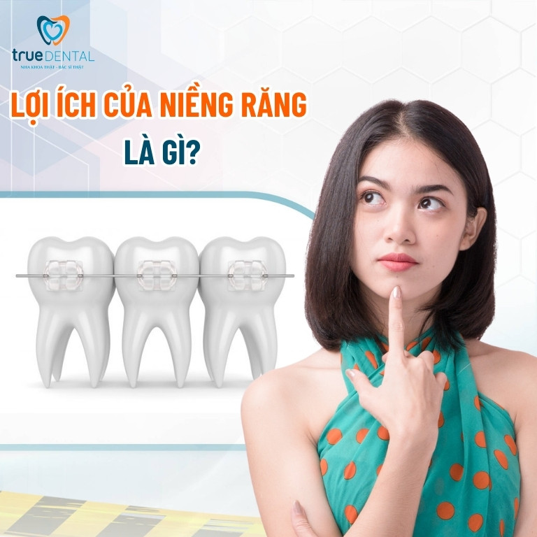 8 lợi ích của niềng răng và một số hiểu lầm thường gặp 2 Lợi ích của niềng răng là gì?