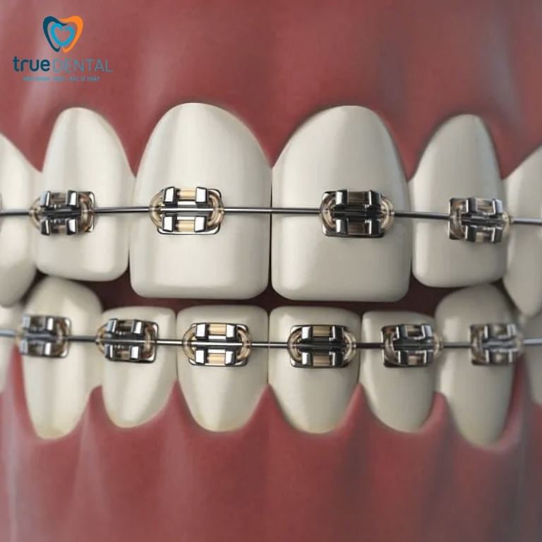 Chi phí niềng răng cửa thưa bao nhiêu tiền? Mất bao lâu? 4 Niềng răng mắc cài