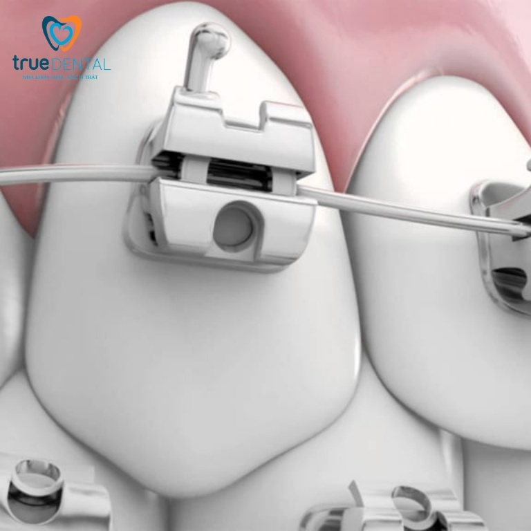 Từ A-Z Về Mắc Cài Tự Động: Chọn Sao Cho Đúng? 2 Mắc cài kim loại tự động
