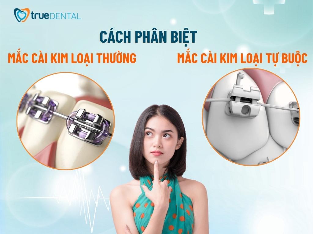 Mắc cài kim loại thường: Ưu, nhược điểm và chi phí 4 Cách phân biệt mắc cài kim loại thường và mắc cài kim loại tự buộc