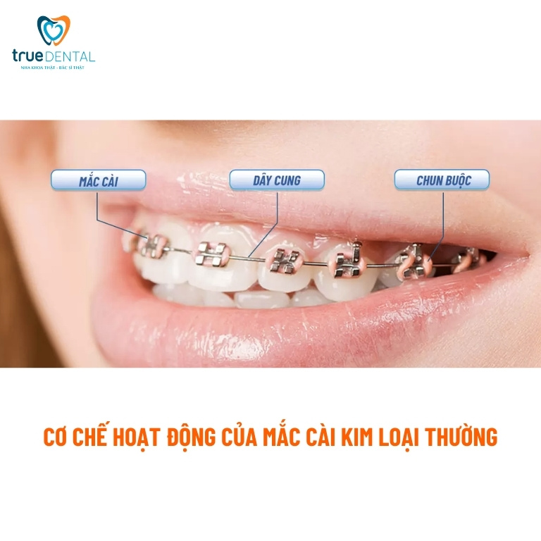 Mắc cài kim loại thường: Ưu, nhược điểm và chi phí 3 Cơ chế hoạt động của mắc cài kim loại thường