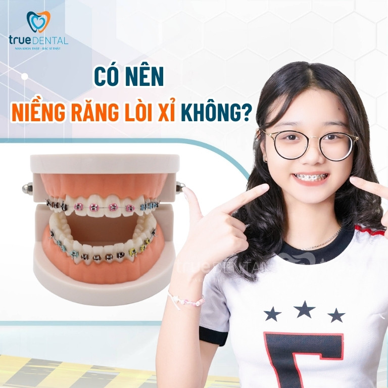 Mắc cài kim loại thường: Ưu, nhược điểm và chi phí 5 Niềng răng mắc cài kim loại thường có tốt không?