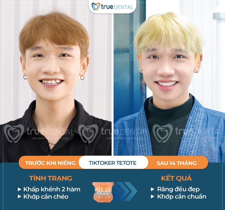 Top 5 nha khoa niềng răng tphcm uy tín nhất 3 hình ảnh kết quả niềng răng ở True Dental
