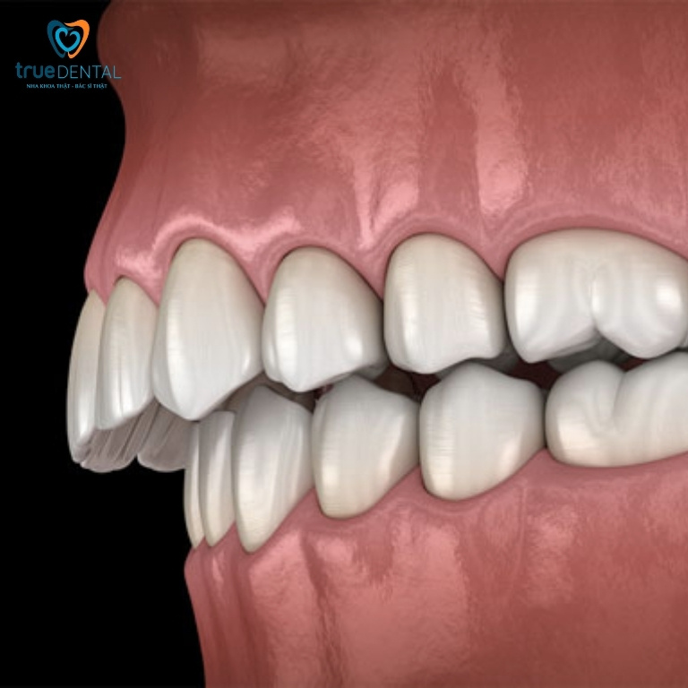 Cách làm răng hết hô tại nhà đơn giản mà hiệu quả 2 Răng hô vẩu hàm trên