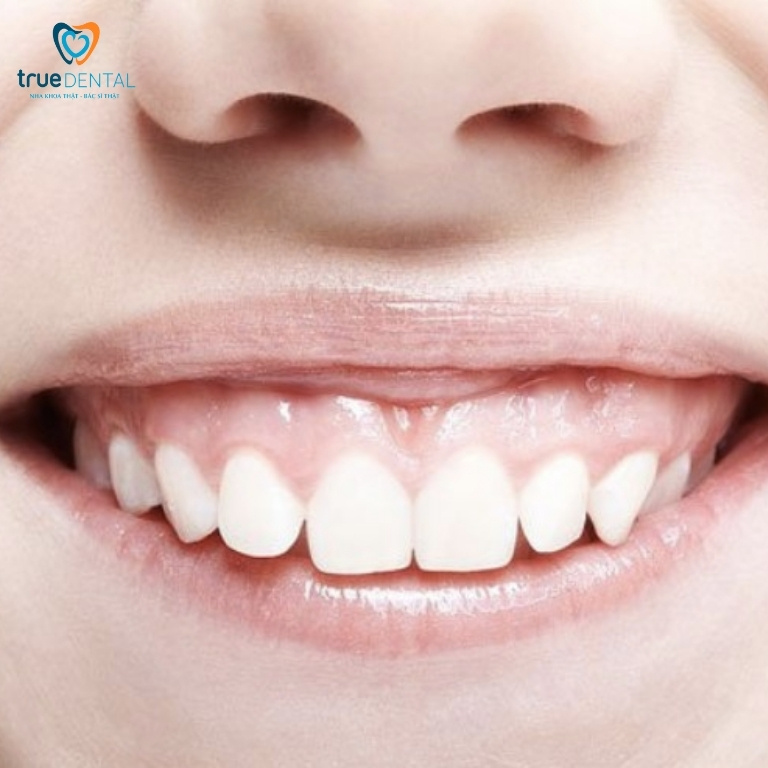 Cách làm răng hết hô tại nhà đơn giản mà hiệu quả 5 Răng hô làm môi dày