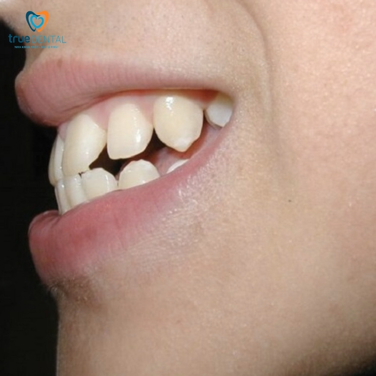 Cách làm răng hết hô tại nhà đơn giản mà hiệu quả 3 Răng hô vẩu hàm dưới