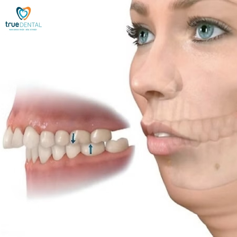 Cách làm răng hết hô tại nhà đơn giản mà hiệu quả 1 Răng hô là gì?