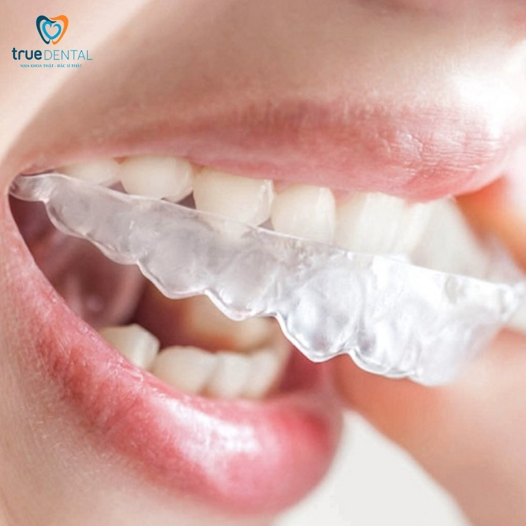 Cách làm răng hết hô tại nhà đơn giản mà hiệu quả 6 Một số cách niềng răng hô tại nhà
