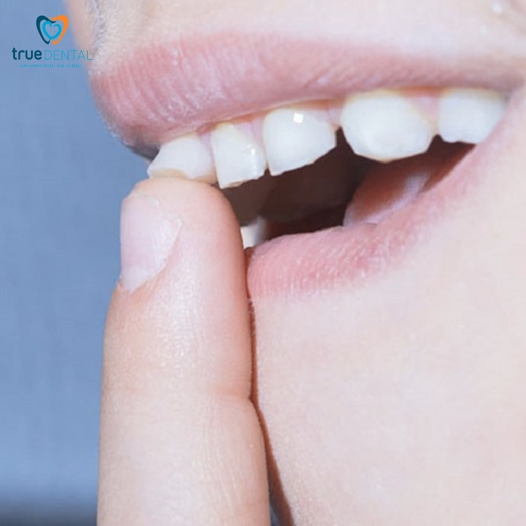 Cách làm răng hết hô tại nhà đơn giản mà hiệu quả 7 Dùng tay đẩy răng chữa hô tại nhà