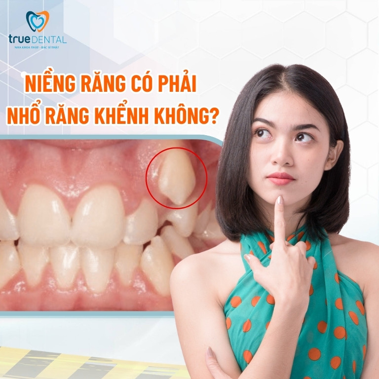 Có nên niềng răng khểnh không? Giá bao nhiêu 4 Niềng răng có phải nhổ răng khểnh không?