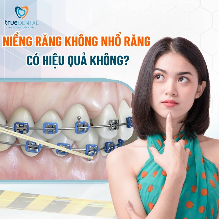 Niềng răng không nhổ răng có hiệu quả không? Trường hợp không nhổ răng khi niềng? 3 Niềng răng không nhổ răng có hiệu quả không?