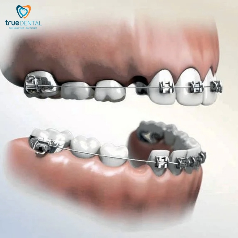 Niềng răng không nhổ răng có hiệu quả không? Trường hợp không nhổ răng khi niềng? 5 Niềng răng thường nhổ những răng nào?