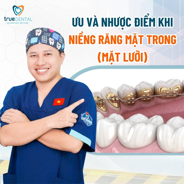 Niềng răng mặt trong là gì? Những điều cần biết về niềng răng mặt lưỡi 2 Ưu và nhược điểm khi niềng răng mặt trong (mặt lưỡi)