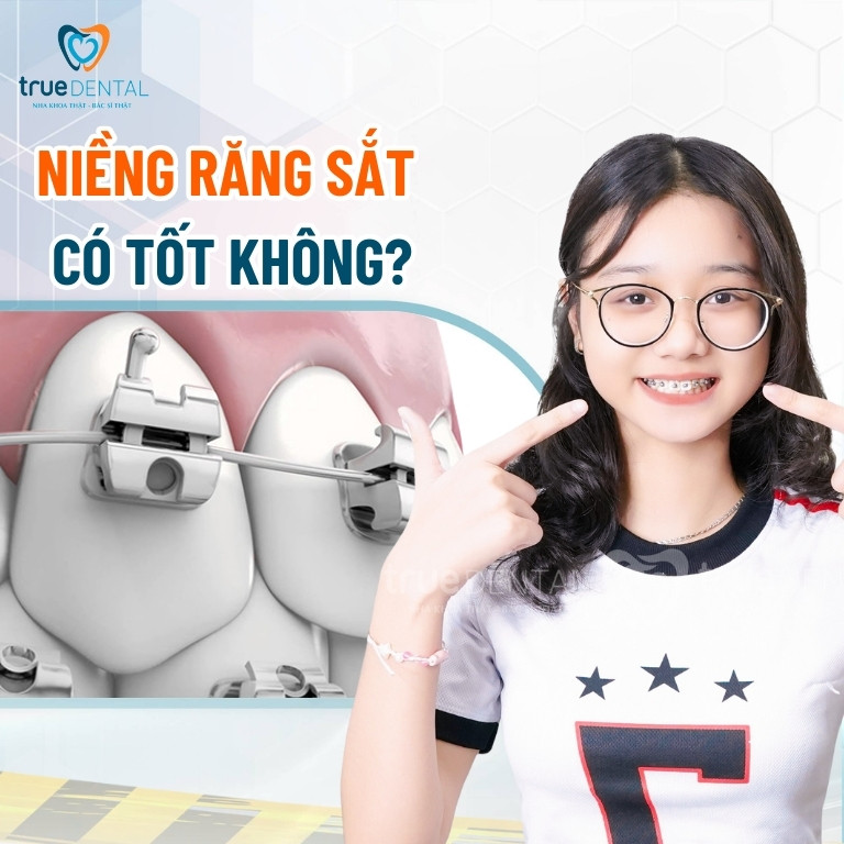 Niềng răng sắt là gì? Thời gian, chi phí, ưu và nhược điểm 2 Niềng răng sắt có tốt không?