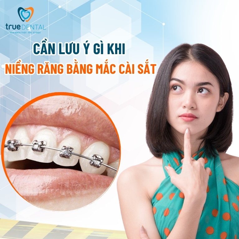 Niềng răng sắt là gì? Thời gian, chi phí, ưu và nhược điểm 8 Lưu ý khi niềng răng bằng mắc cài sắt