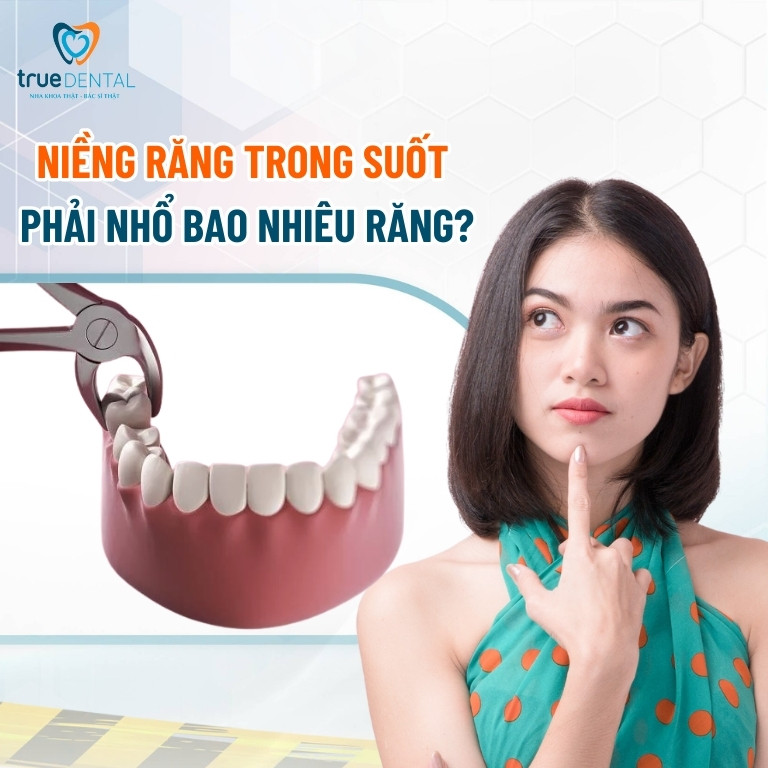 Niềng răng trong suốt có phải nhổ răng không? - Bác sĩ giải đáp 5 Niềng răng trong suốt phải nhổ bao nhiêu răng?