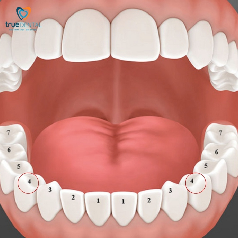 Niềng răng trong suốt có phải nhổ răng không? - Bác sĩ giải đáp 6 Răng số 4 được chỉ định nhổ khi chỉnh nha trong suốt