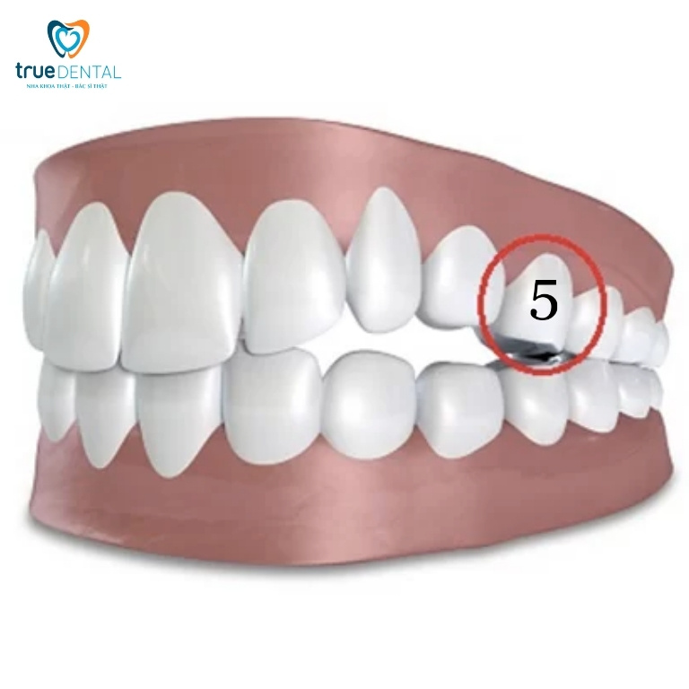 Niềng răng trong suốt có phải nhổ răng không? - Bác sĩ giải đáp 7 Răng số 5 được chỉ định nhổ khi chỉnh nha trong suốt