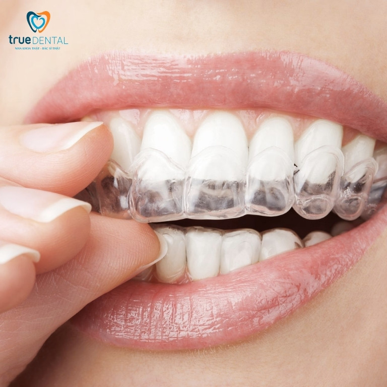 Niềng răng trong suốt mất bao lâu để đạt hiệu quả? 1 Niềng răng trong suốt là gì?