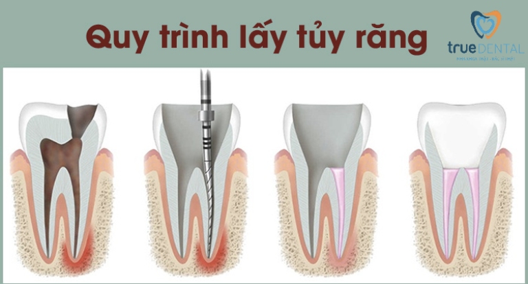 Quy trình lấy tủy răng chuẩn Y khoa với 7 bước 3 Mở buồng tuỷ, rút tủy viêm