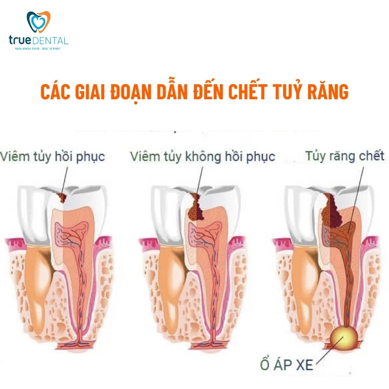Răng chết tuỷ: Nguyên nhân, dấu hiệu và cách điều trị 6 Các giai đoạn dẫn đến chết tuỷ răng