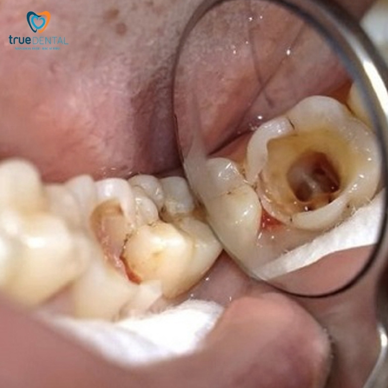 Răng chết tuỷ: Nguyên nhân, dấu hiệu và cách điều trị 8 Răng chết tuỷ tồn tại được bao lâu?