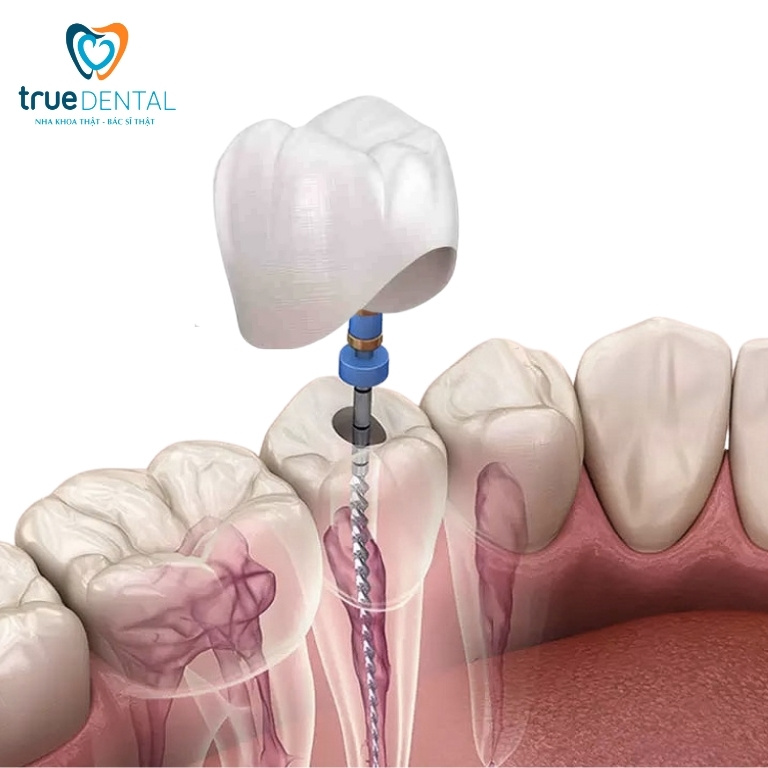 Răng chết tuỷ: Nguyên nhân, dấu hiệu và cách điều trị 10 Bọc răng sứ sau khi điều trị tủy