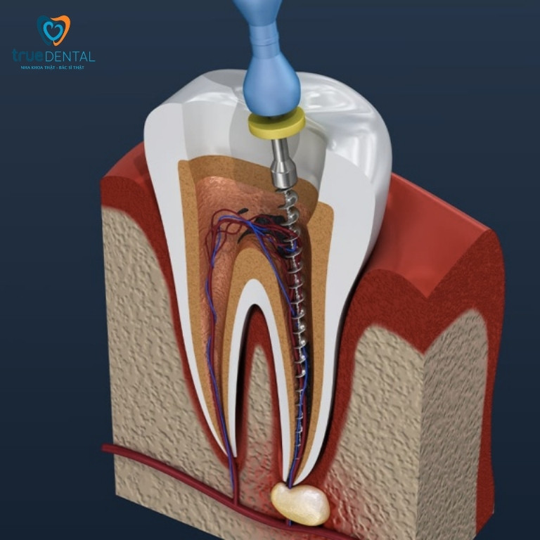 Răng chết tuỷ: Nguyên nhân, dấu hiệu và cách điều trị 9 Điều trị nội nha cho răng chết tuỷ