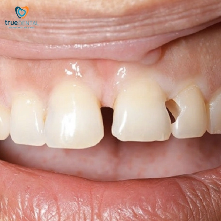 Răng chết tuỷ: Nguyên nhân, dấu hiệu và cách điều trị 5 Chết tuỷ do răng gãy, nứt, vỡ mẻ