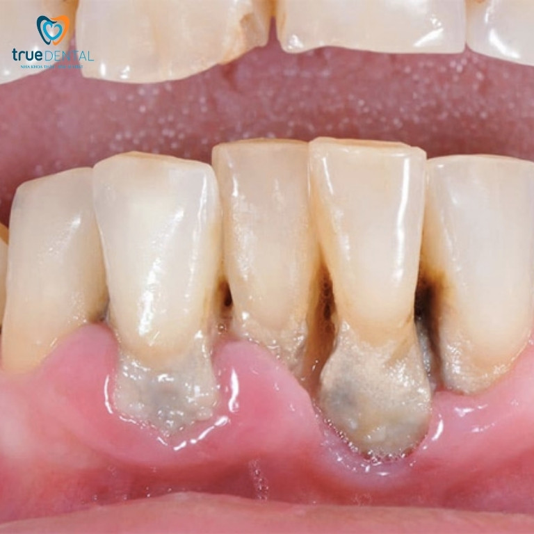 Răng chết tuỷ: Nguyên nhân, dấu hiệu và cách điều trị 4 Tuỷ răng chết do viêm nha chu, nhiễm trùng nướu