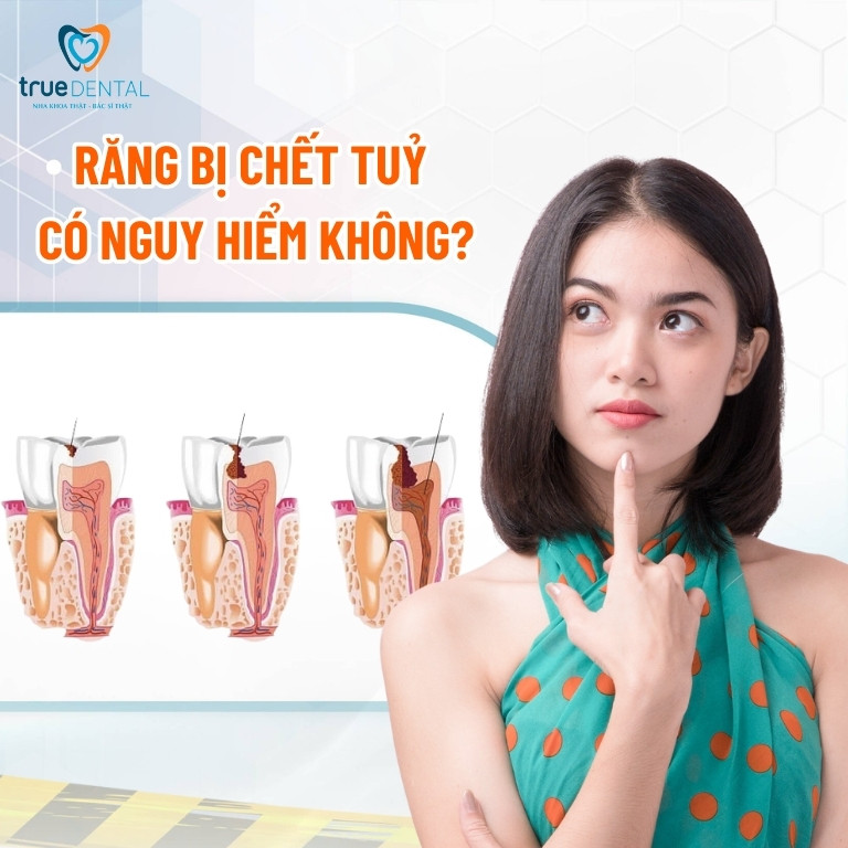 Răng chết tuỷ: Nguyên nhân, dấu hiệu và cách điều trị 7 Răng bị chết tuỷ có nguy hiểm không?