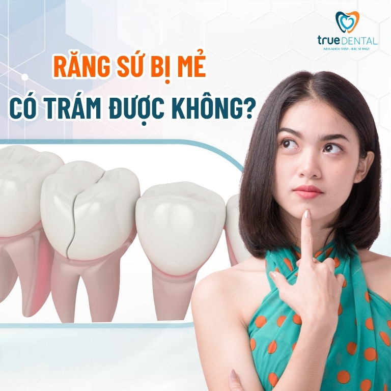 Răng sứ bị mẻ có trám được không? Làm gì khi răng sứ vỡ, mẻ? 3 Răng sứ bị mẻ có trám được không?