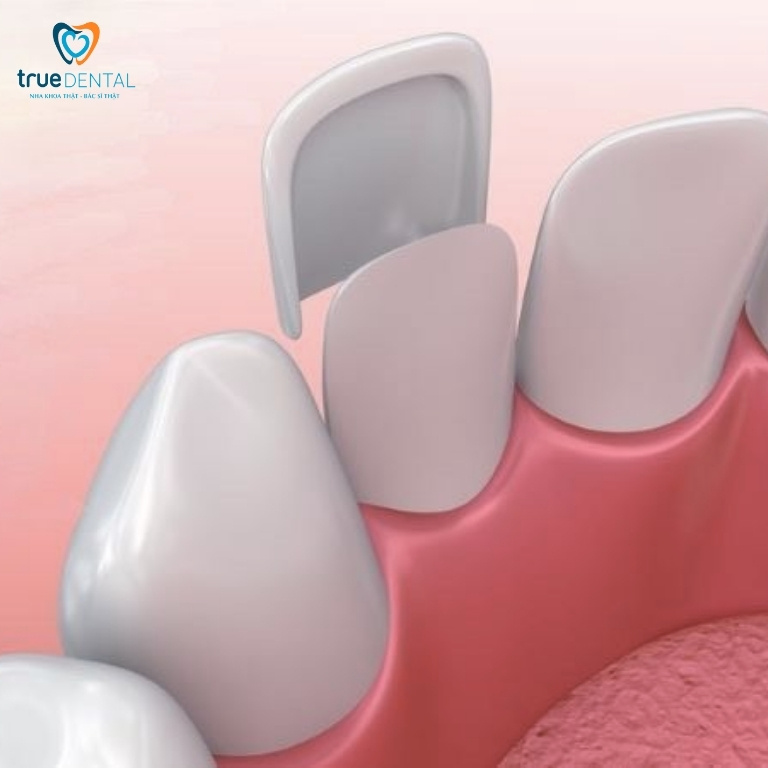 Răng sứ bị mẻ có trám được không? Làm gì khi răng sứ vỡ, mẻ? 6 Dán răng sứ lại