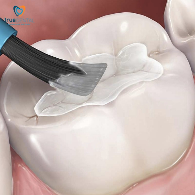 Trám răng thẩm mỹ: Quy trình, chi phí và những điều cần biết 1 Trám răng thẩm mỹ là gì?