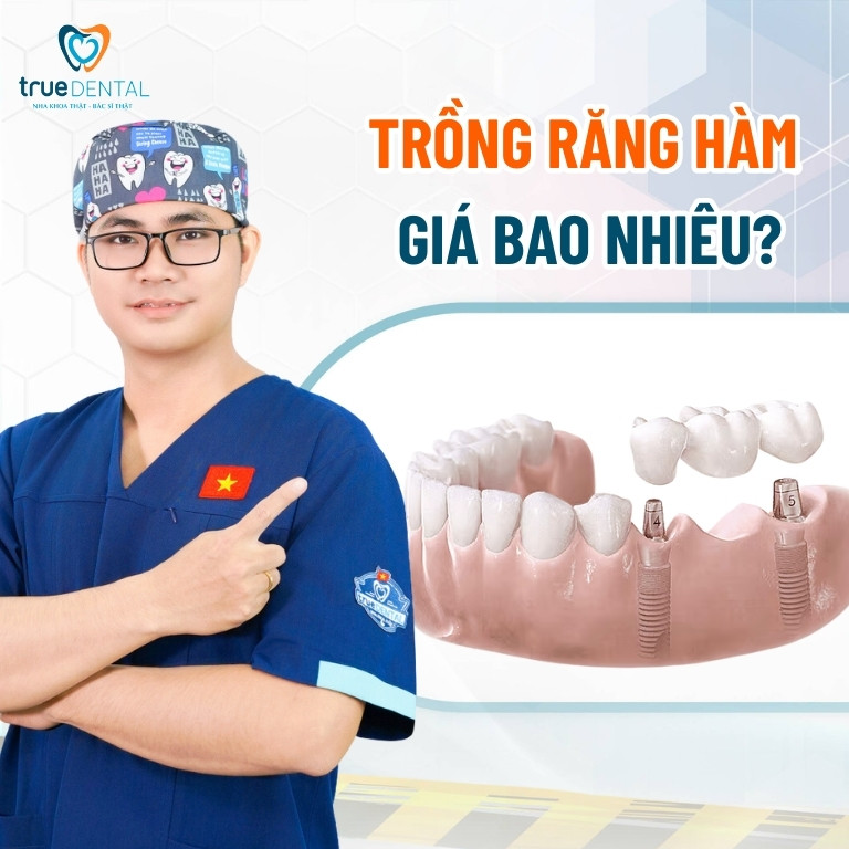Trồng răng hàm giá bao nhiêu tiền? Phương pháp nào hiệu quả 6 Trồng răng hàm giá bao nhiêu?