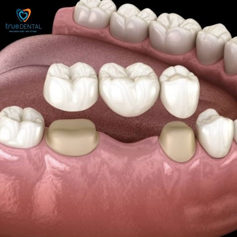 Trồng răng hàm giá bao nhiêu tiền? Phương pháp nào hiệu quả 5 Cầu răng sứ phục hình răng hàm