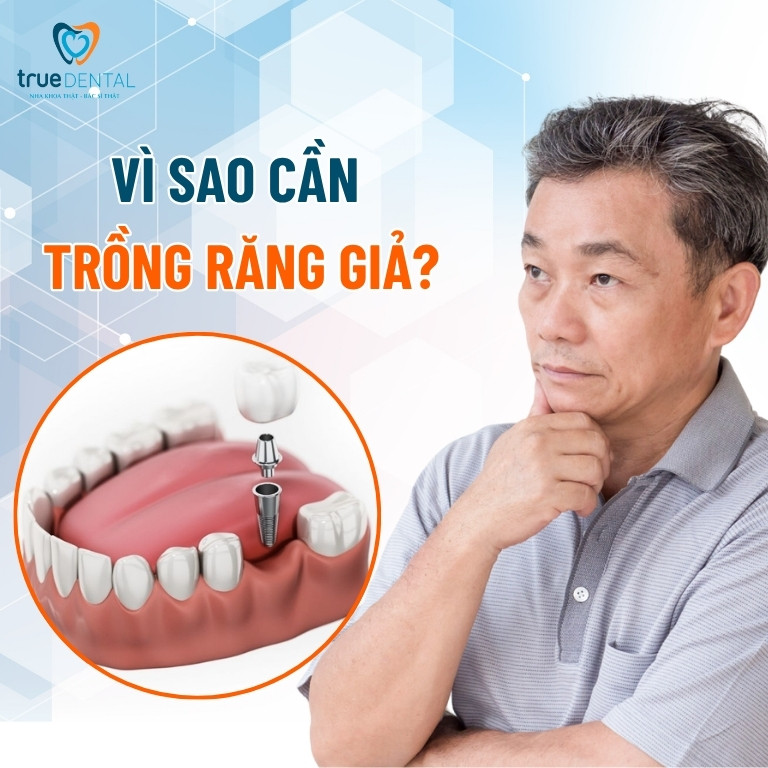 Chi phí trồng răng giả giá bao nhiêu tiền 1 cái? Bảng giá 2025 5 Vì sao cần trồng răng giả?