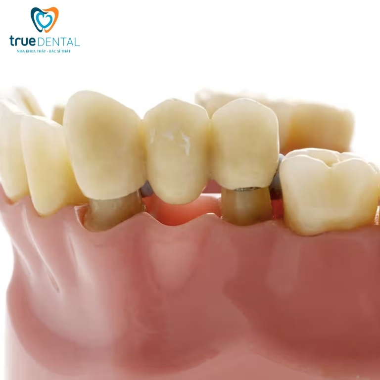 Trồng răng giả mất bao lâu để hoàn thành? 3 cầu răng sứ