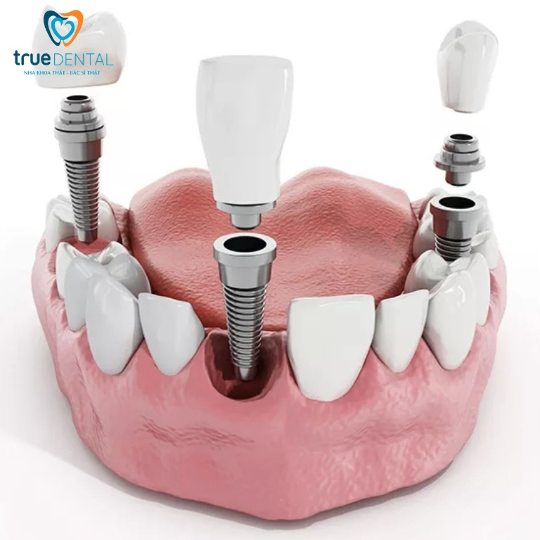 Trồng răng giả mất bao lâu để hoàn thành? 4 cấy ghép implant