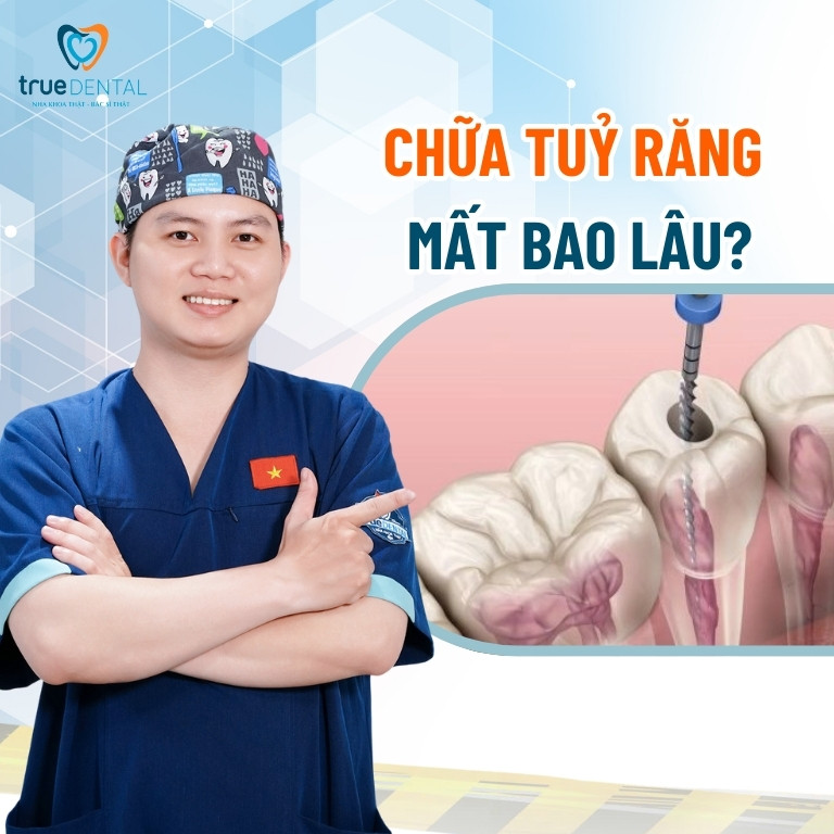 Chữa tủy răng mất bao lâu? 5 yếu tố ảnh hưởng thời gian lấy tuỷ 3 Chữa tuỷ răng mất bao lâu?