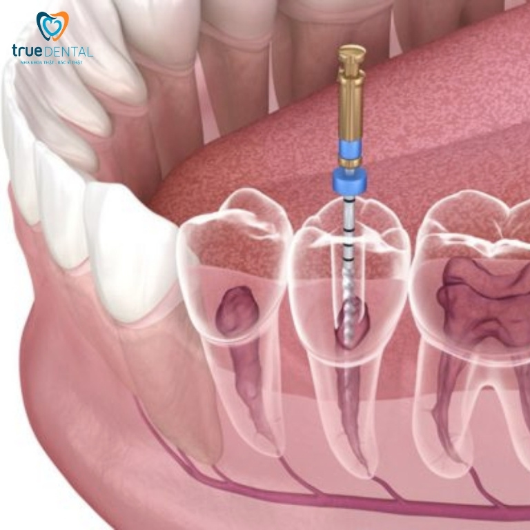 Chữa tủy răng mất bao lâu? 5 yếu tố ảnh hưởng thời gian lấy tuỷ 7 Tuổi thọ răng đã chữa tuỷ kéo dài bao lâu?