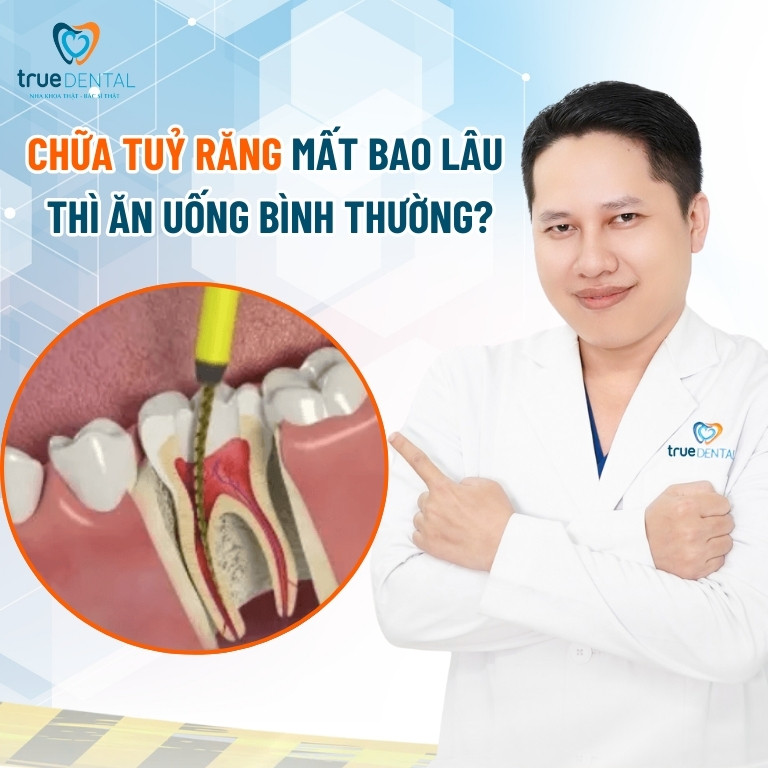 Chữa tủy răng mất bao lâu? 5 yếu tố ảnh hưởng thời gian lấy tuỷ 6 Chữa tuỷ răng mất bao lâu thì ăn uống được bình thường?