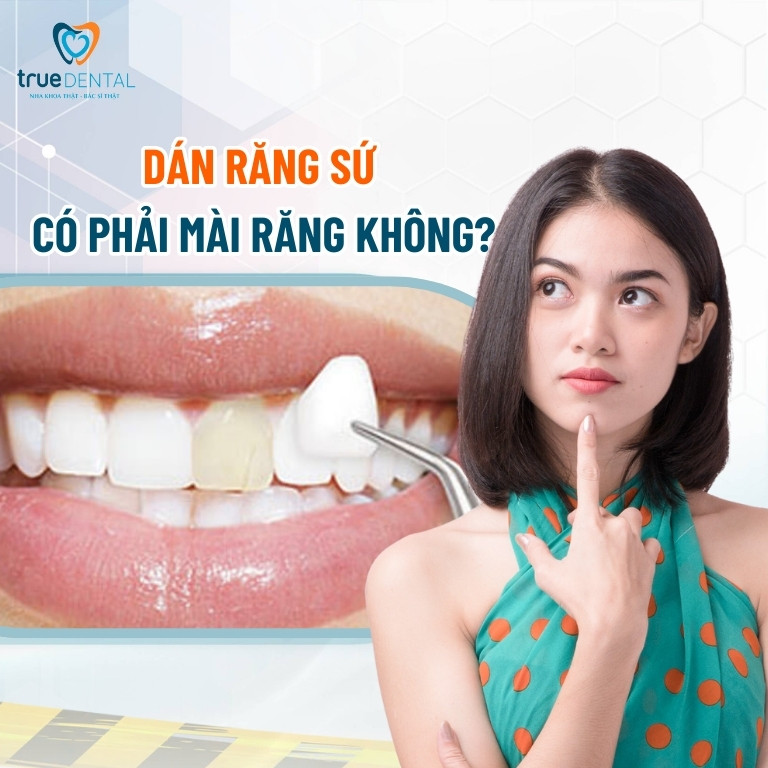 Kỹ thuật dán sứ veneer không mài răng là gì? 1 Dán răng sứ có phải mài răng không?