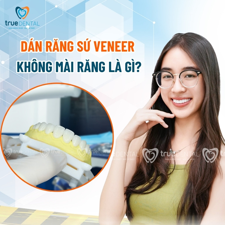 Kỹ thuật dán sứ veneer không mài răng là gì? 2 Dán sứ Veneer không mài răng là gì?