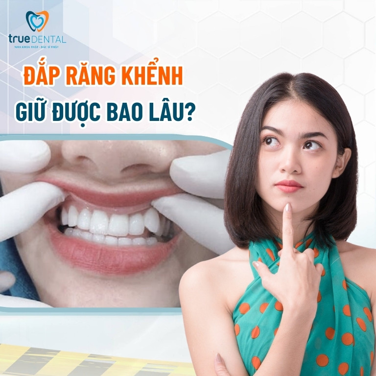 Đắp răng khểnh giữ được bao lâu?