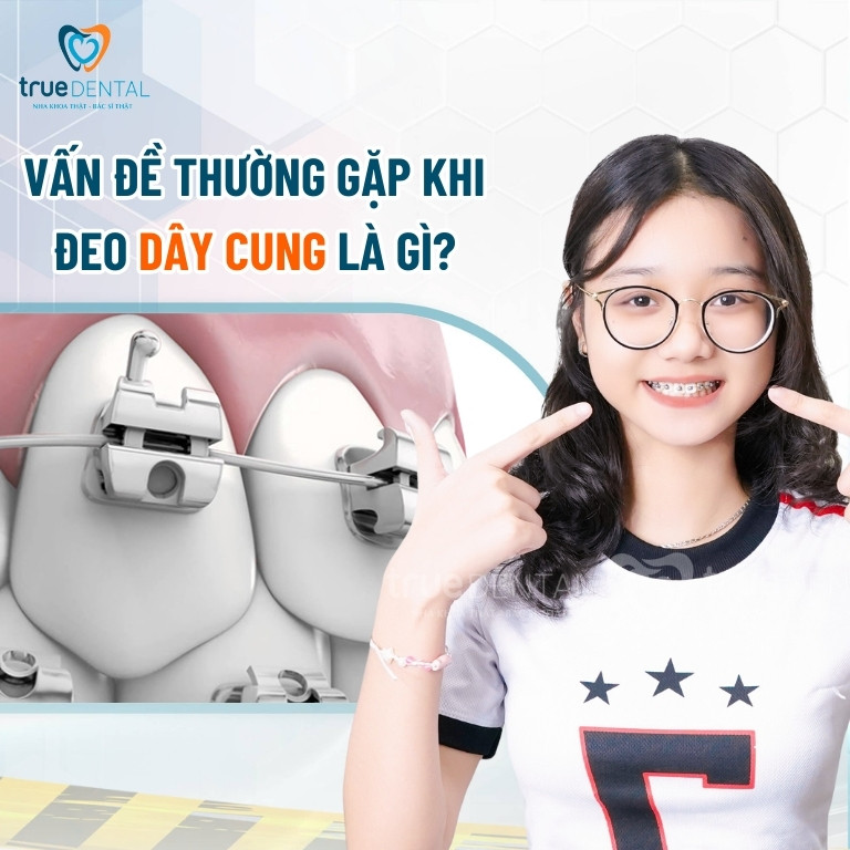 Dây cung niềng răng có tác dụng gì? Có bao nhiêu loại? 10 Các vấn đền thường gặp khi đeo dây cung là gì?
