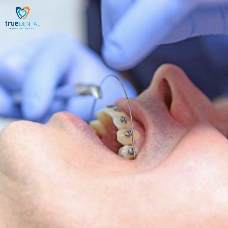 Dây cung niềng răng có tác dụng gì? Có bao nhiêu loại? 1 Dây cung niềng răng là gì?