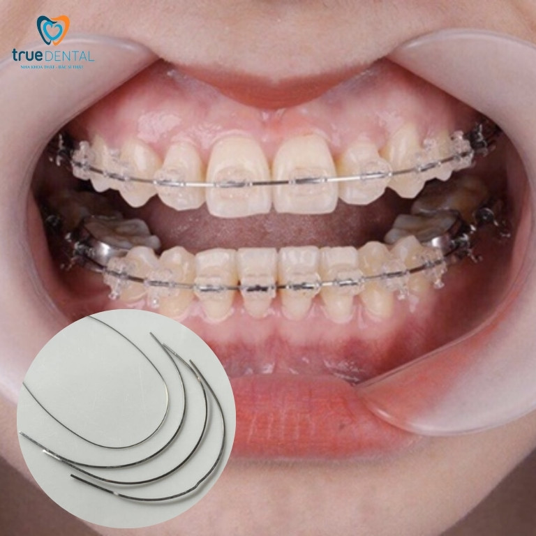 Dây cung niềng răng có tác dụng gì? Có bao nhiêu loại? 2 Kích thước dây cung niềng răng