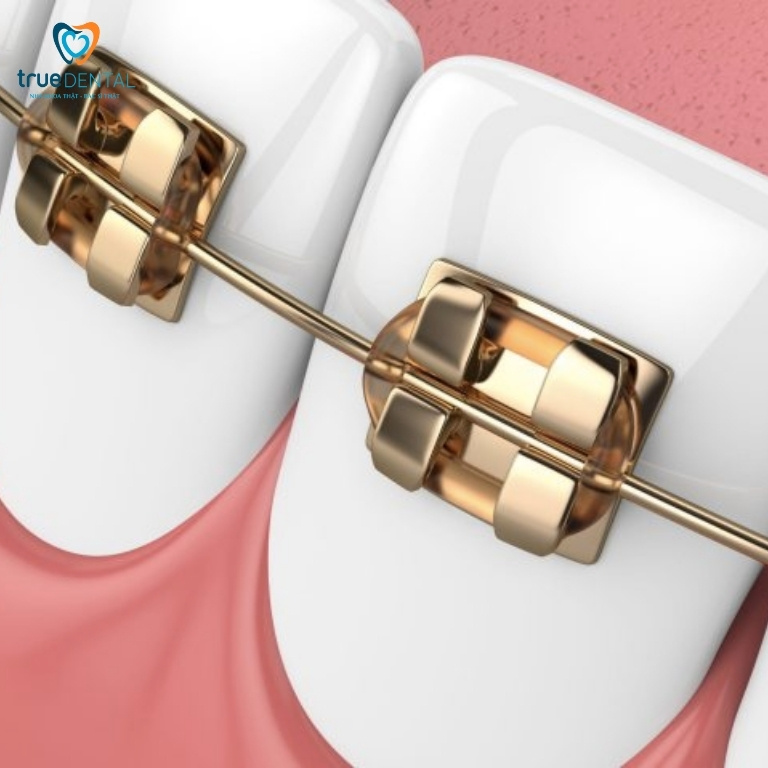 Dây cung niềng răng có tác dụng gì? Có bao nhiêu loại? 4 Dây cung được chế tạo từ hợp kim kim loại