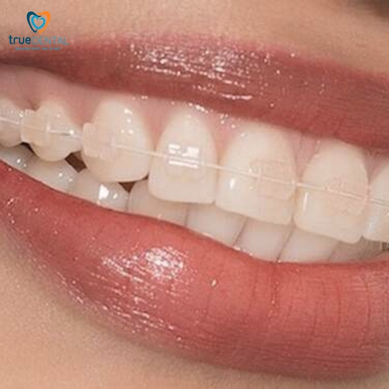 Dây cung niềng răng có tác dụng gì? Có bao nhiêu loại? 9 Dây cung niềng sứ